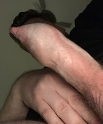 Phimoforeskin